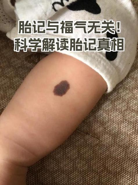 脖子右胎记女性命运如何改写？