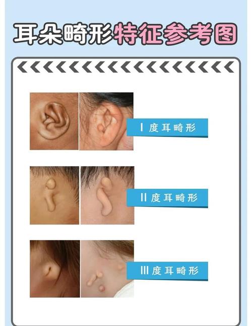 右耳下胎记和耳朵前胎记分别预示着怎样的命运？