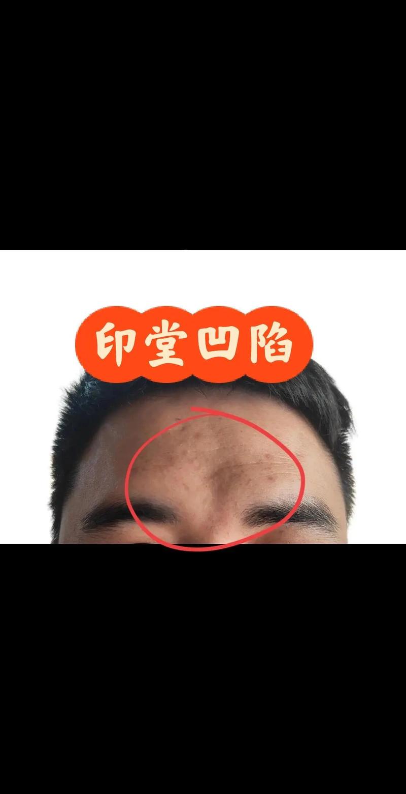 脸部凹痕对家居风水有影响吗？