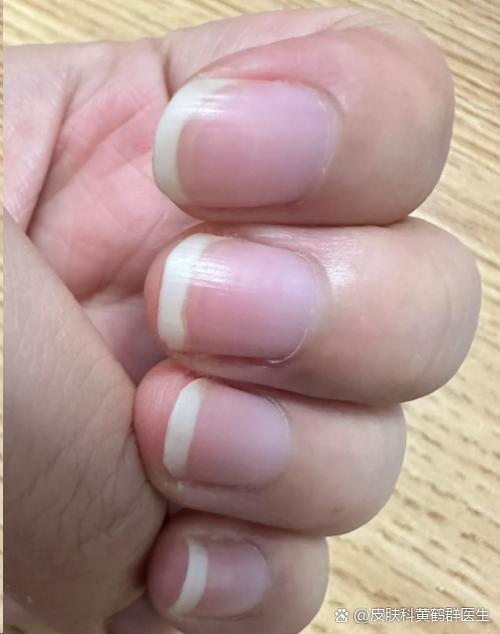 男生指甲红润是健康好命的表现吗？