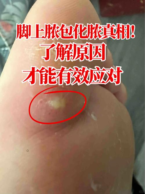 脚底流脓是否意味着居住地风水不佳？