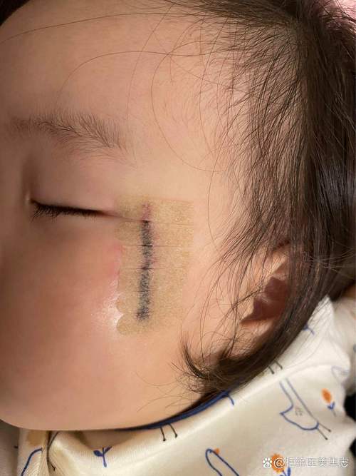 眼睛周围胎记代表什么命运？贵子胎记出现在六个部位有何特殊含义？