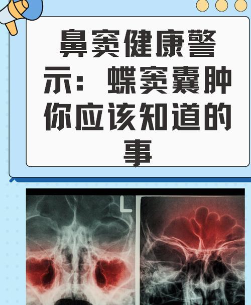 家里长囊肿和头疼与风水有关吗？