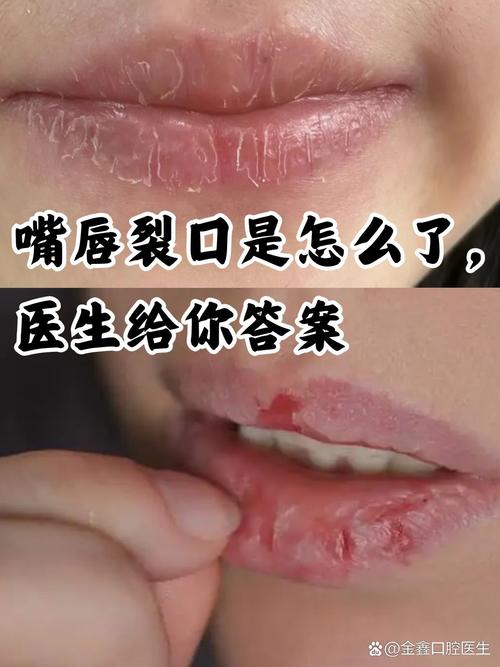 嘴唇破裂是否会对家庭风水产生不良影响？