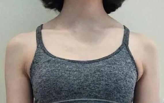 没有脖子的人命运如何？脖子短是天生的吗？