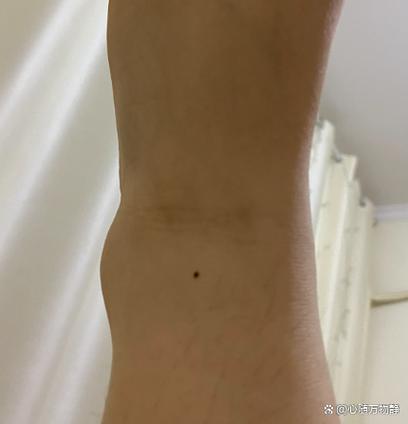 女人左脚脚踝有痣，是否预示着某种特殊命运？