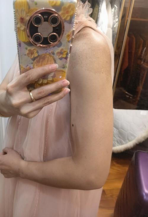 肩膀胎记命运如何，位置影响吉凶几何？