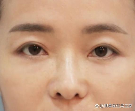 眼周受伤对家居风水有影响吗？