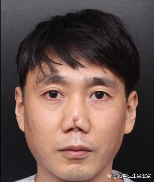 隆鼻手术会对我的面部风水产生怎样的影响呢？