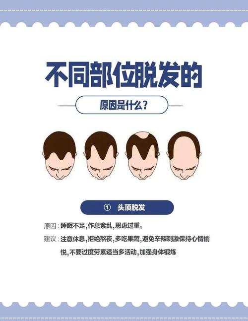 额头脱发预示着怎样的命运？