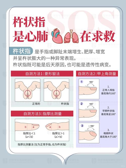 手指指甲圆形鼓起来是哪种病症的征兆？