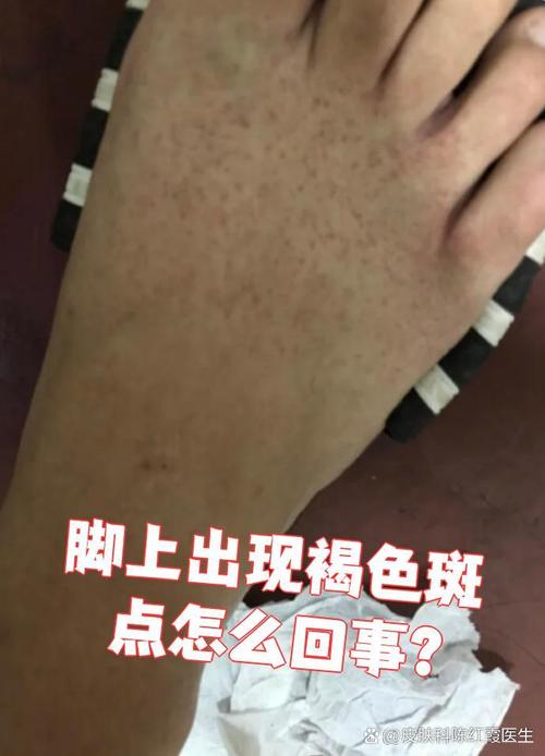 脚面出现黑色印记或斑点是什么命理含义？