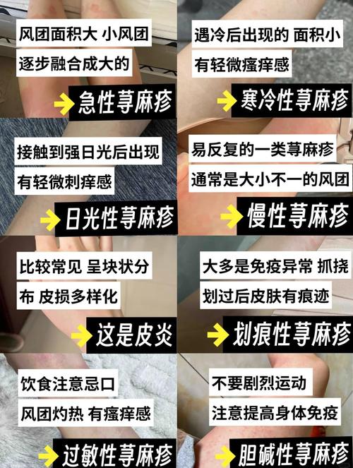 风水疙瘩是寻麻疹的一种症状吗？