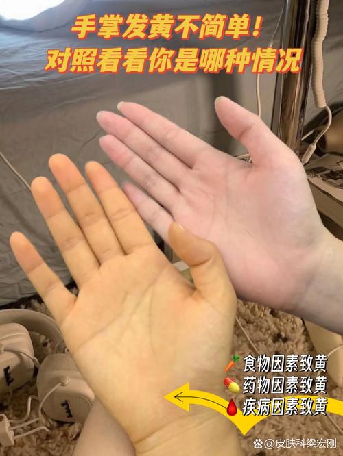 手掌发黄预示着什么命运，是好是坏？