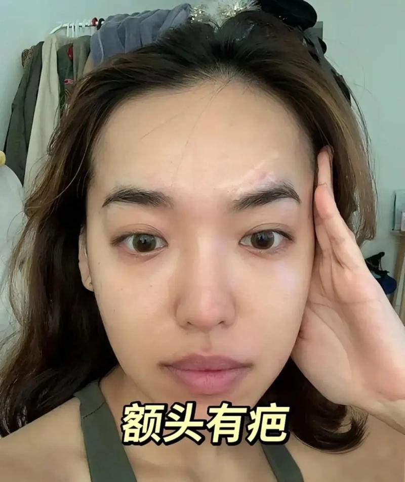 额头正中有疤痕面相命运如何？
