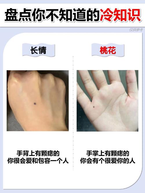 手背上长瘊子，这人的命运究竟有何特殊含义？