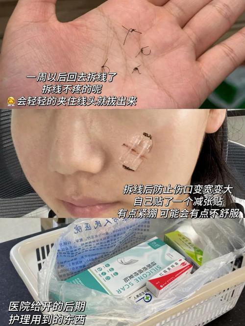 切除痣会对女性风水产生什么影响？