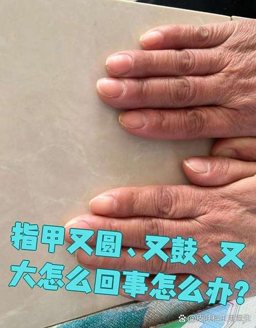 手指指甲圆形鼓起来是哪种病症的征兆？