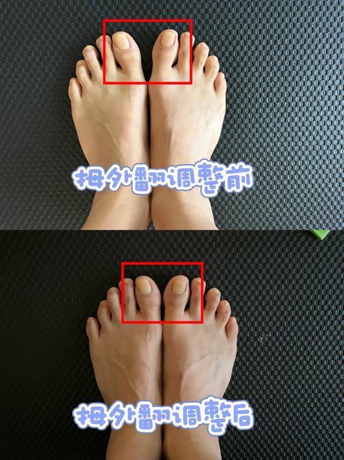 脚趾都不挨着和脚趾头紧挨在一起，哪种命运更佳？