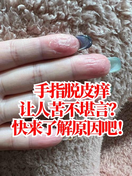每年手部频繁脱皮，这是否意味着某种命运？手上老蜕皮现象究竟是怎么回事？