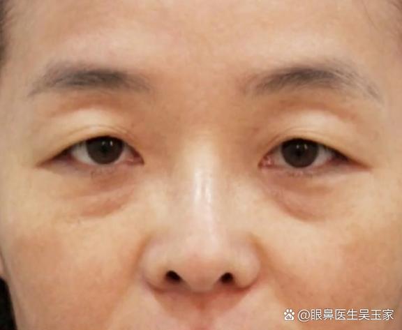 眼周受伤对家居风水有影响吗？