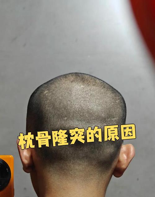 枕骨凸起的人命运如何改写？