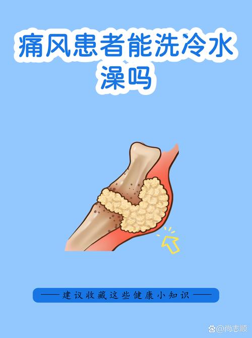 痛风水肿严重时可以采取放水疗法缓解吗？