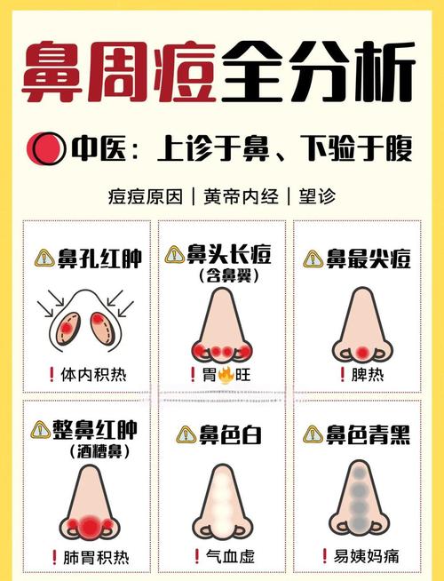 鼻尖长痘是否会影响风水布局？