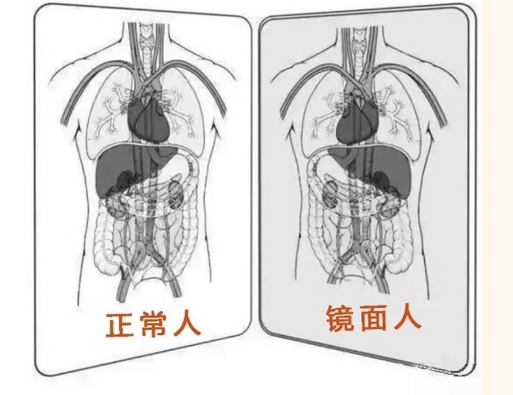 镜像内脏的人命运如何？镜像人与常人是否相同？