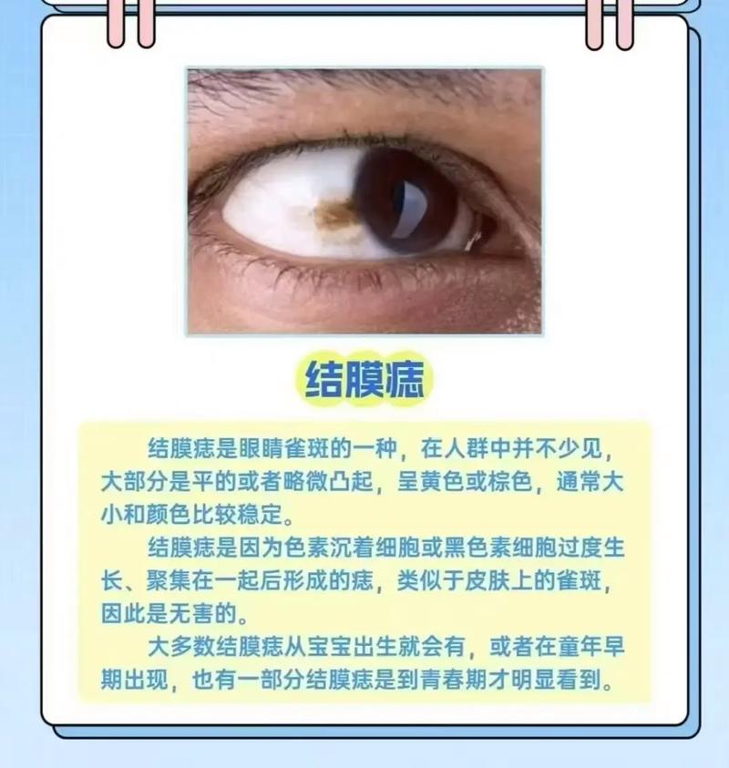 眼珠黑点眼皮黑点，预示吉凶如何？