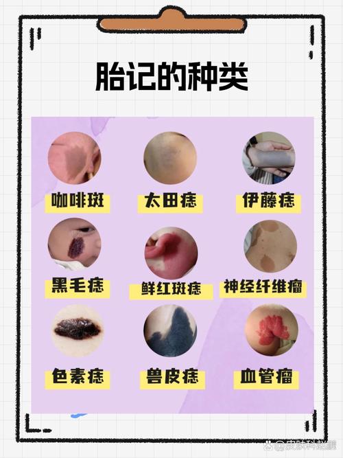 去除胎记对男孩的运势和风水有影响吗？