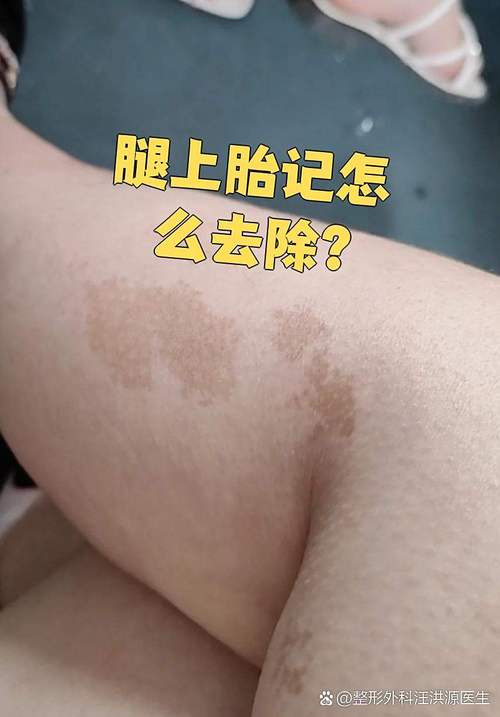 腿上爱心胎记命运如何，胎记位置对人生有何影响？