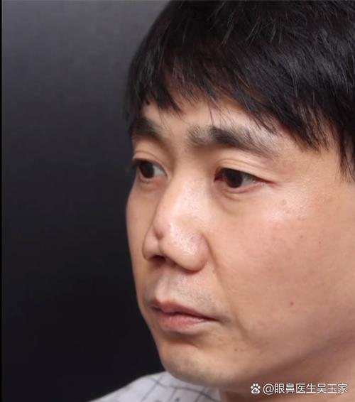 隆鼻手术会对我的面部风水产生怎样的影响呢？