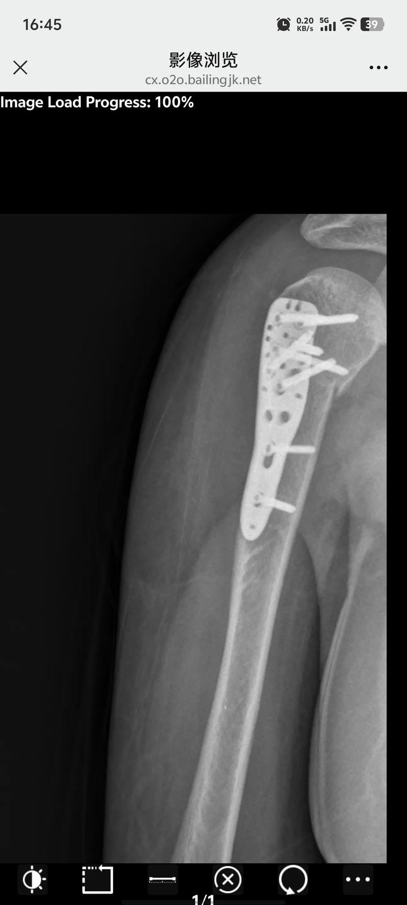 女命手臂骨折是何命格？骨折为何嫩挡灾改命？