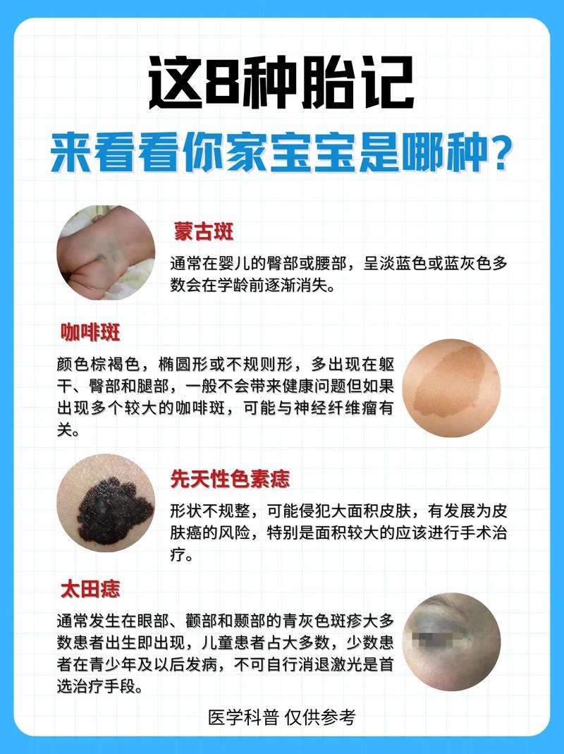 男孩左脸胎记预示着怎样的命运或福气？