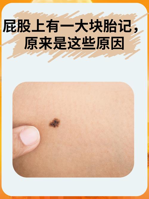 屁股胎记命运如何影响人生？