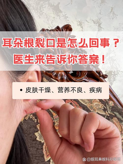 耳朵外轮廓裂开口子，这是否预示着某种命运？
