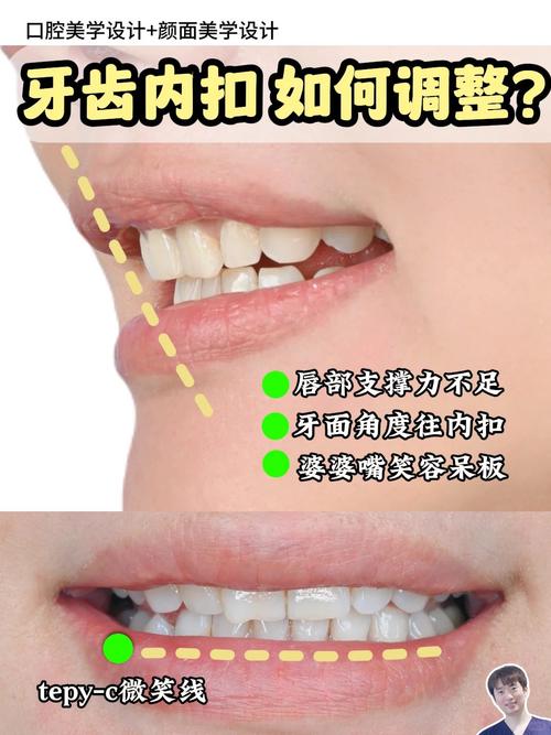 牙齿内扣与风水之间是否存在关联？