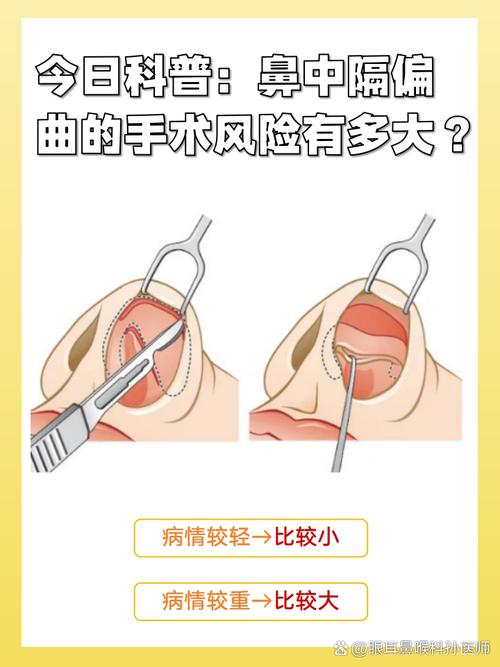 隆鼻手术真的会影响家庭风水吗？
