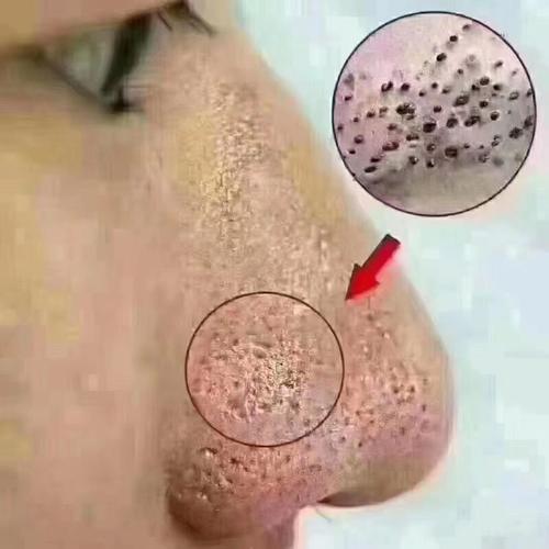 酒渣鼻男人的命运是否可以通过改变生活方式来改善？