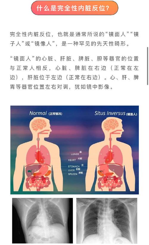 镜像内脏的人命运如何？镜像人与常人是否相同？