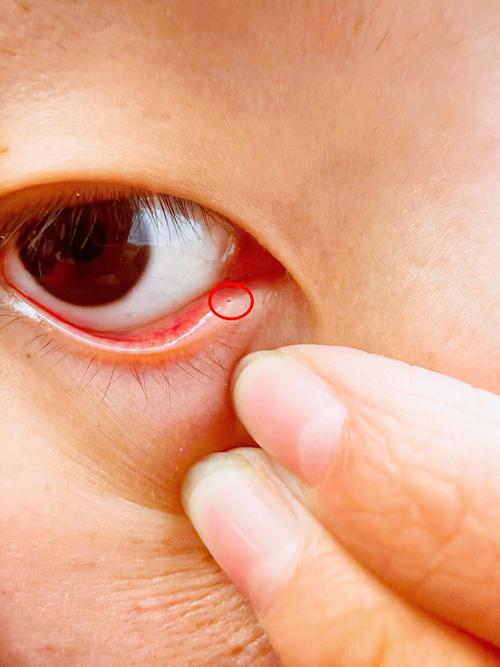 眼角有小洞或旁边有洞的命理意义是什么？