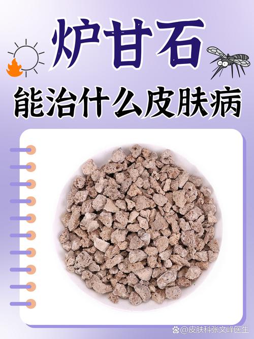 风水疙瘩可依用炉甘石涂抹吗？哪种情况下适用？