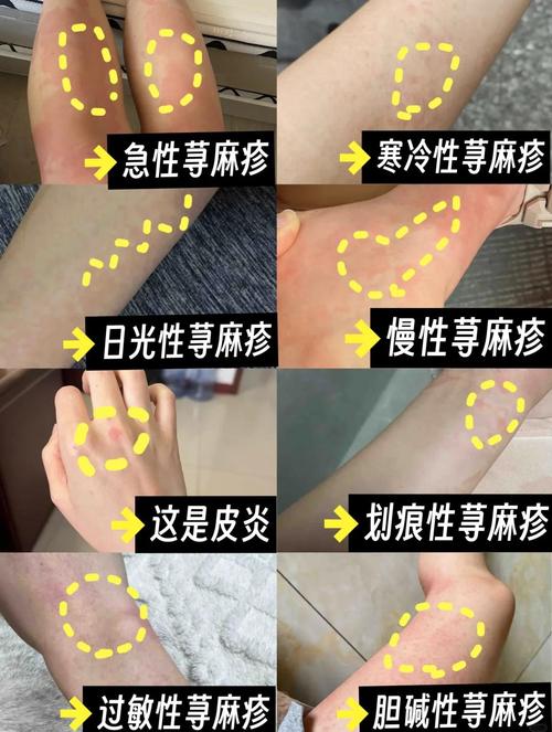 风水疙瘩是寻麻疹的一种症状吗？