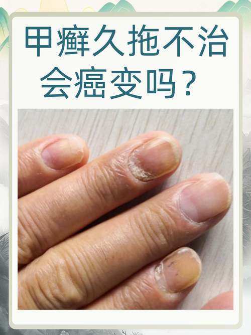 命毒命硬的人，指甲硬的命，到底好不好？