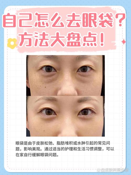 去除眼袋会对家庭风水产生什么影响？