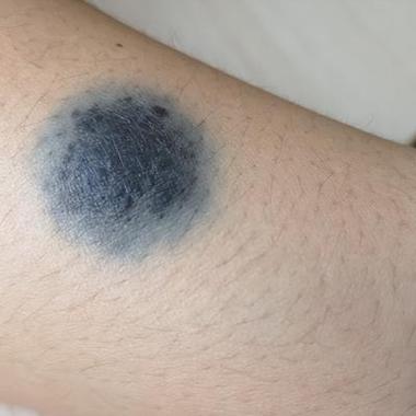 腿上爱心胎记命运如何，胎记位置对人生有何影响？